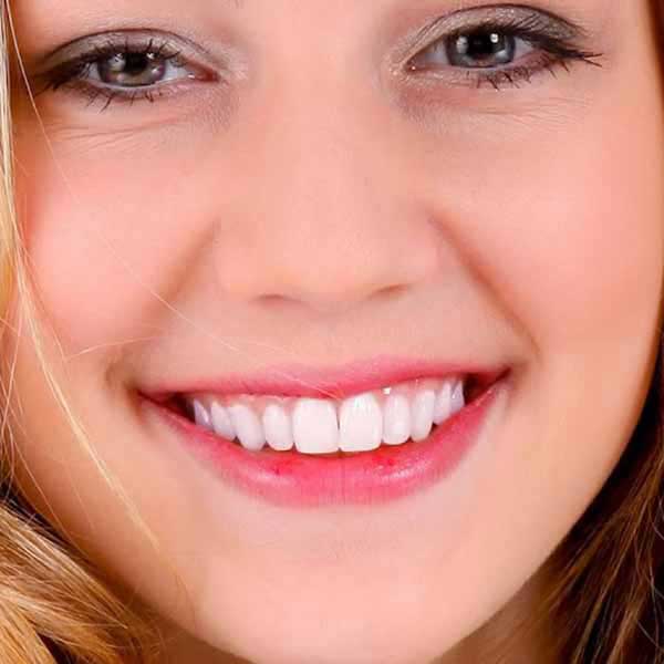 After tooth whitening treatment with visibly whiter teeth at Rajarhat Dental Hall
