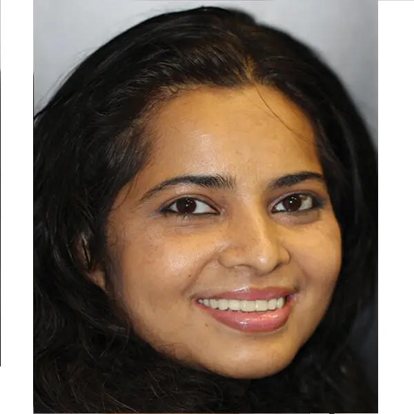 After tooth veneers treatment with visibly whiter teeth at Rajarhat Dental Hall