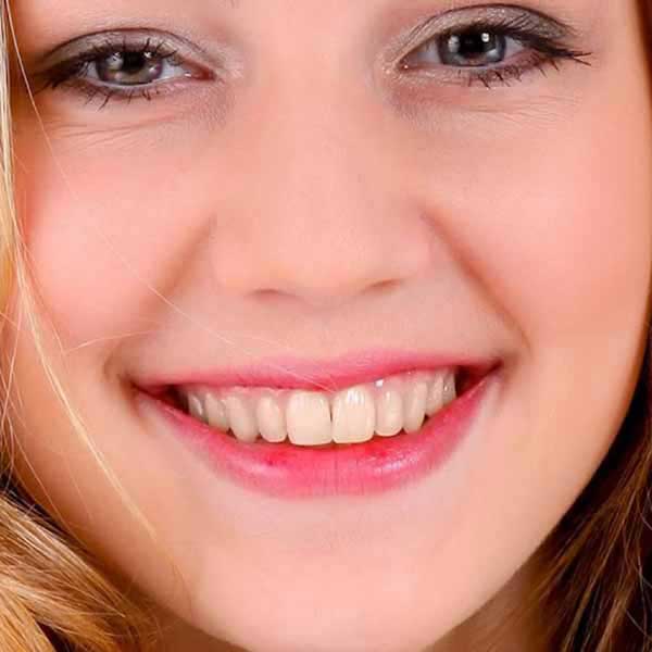 Before tooth whitening treatment at Rajarhat Dental Hall