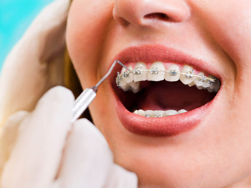 Dental Braces or Tooth Brace Treatment in Rajarhat