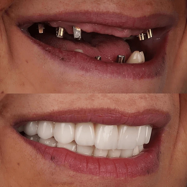 Dental Implant in Kolkata to replace missing teeth in Rajarhat