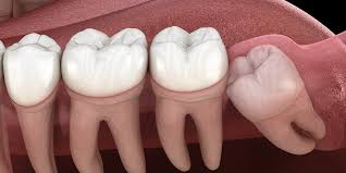 Wisdom Tooth Removal in Rajarhat