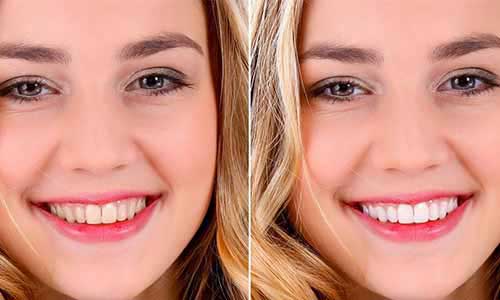 Teeth Whitening Cost in Rajarhat New Town