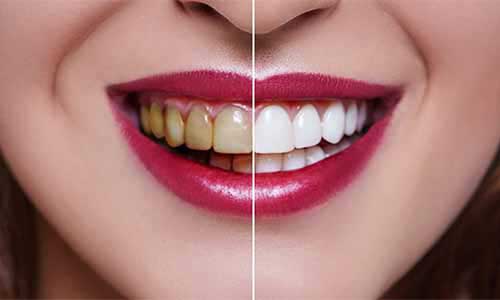 Teeth Whitening in New Town Rajarhat