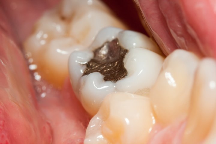 Tooth Filling Cost in Rajarhat New Town